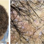 Alopecie cicatricielle centrale centrifuge (CCCA) : le danger silencieux qui menace les femmes noires