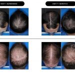 Clascotérone : la molécule qui pourrait bouleverser le traitement de la calvitie